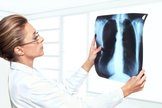 doctor_holding_xray Doctor Holding Xrays looking for carbon monoxide poisoning.